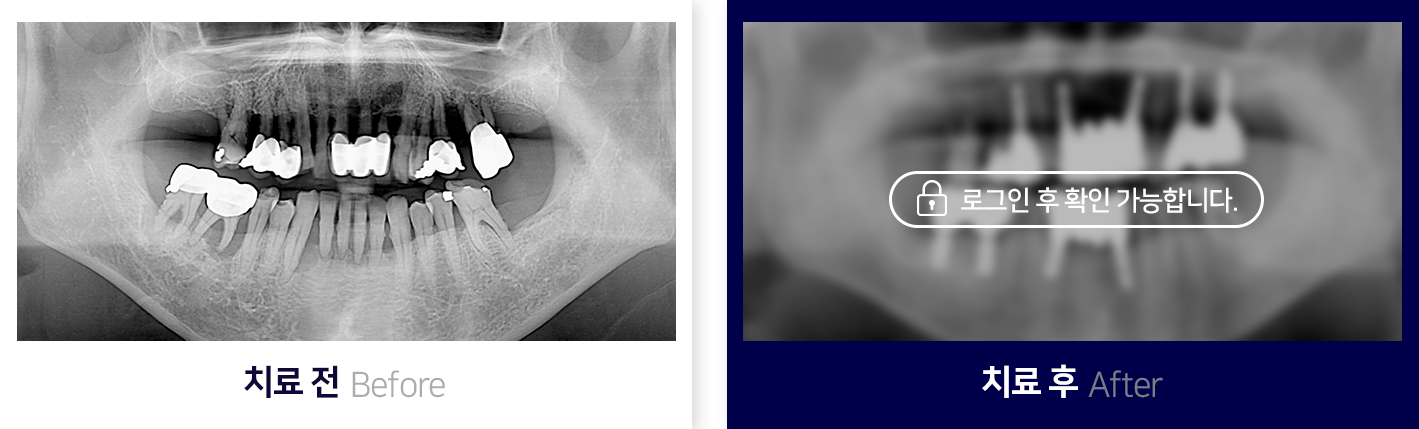 임플란트-전후사진1