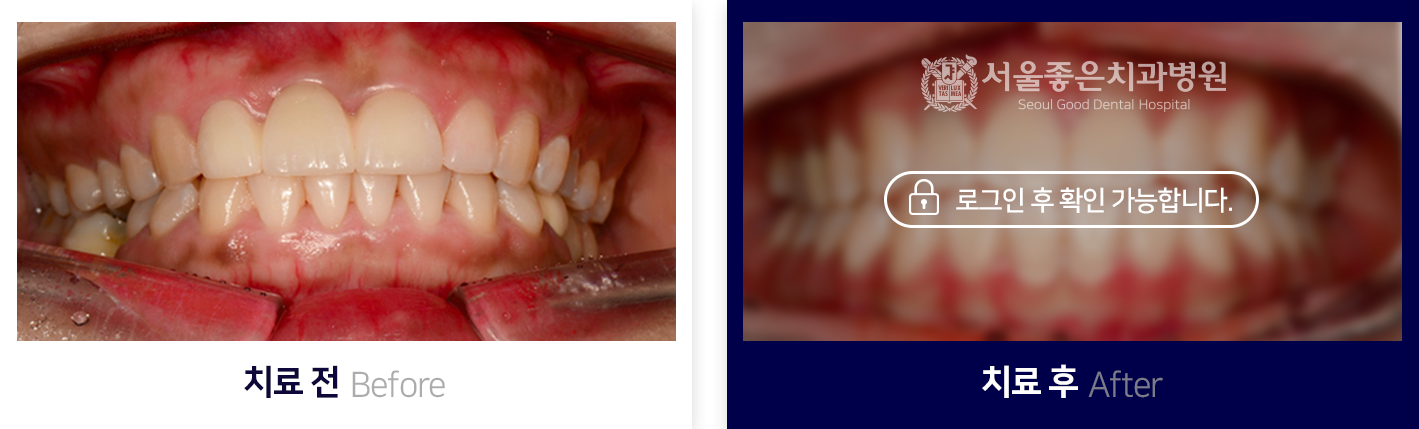 치아교정-전후사진1