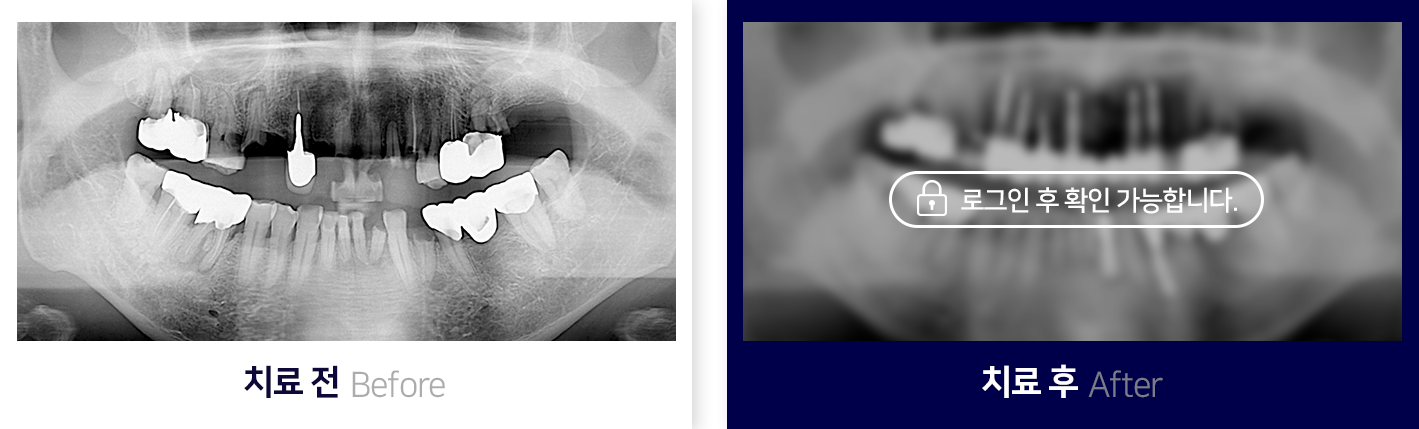 임플란트-전후사진2