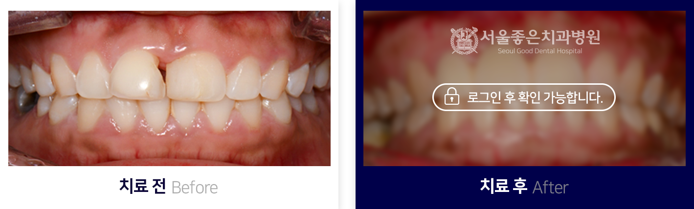 치아교정-전후사진2