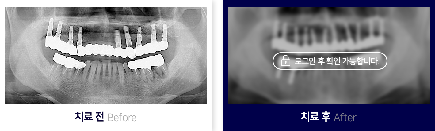임플란트-전후사진3