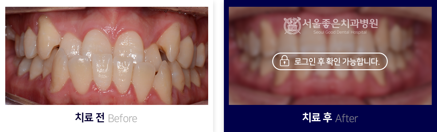 치아교정-전후사진3