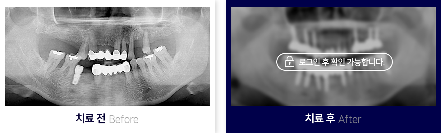 임플란트-전후사진4
