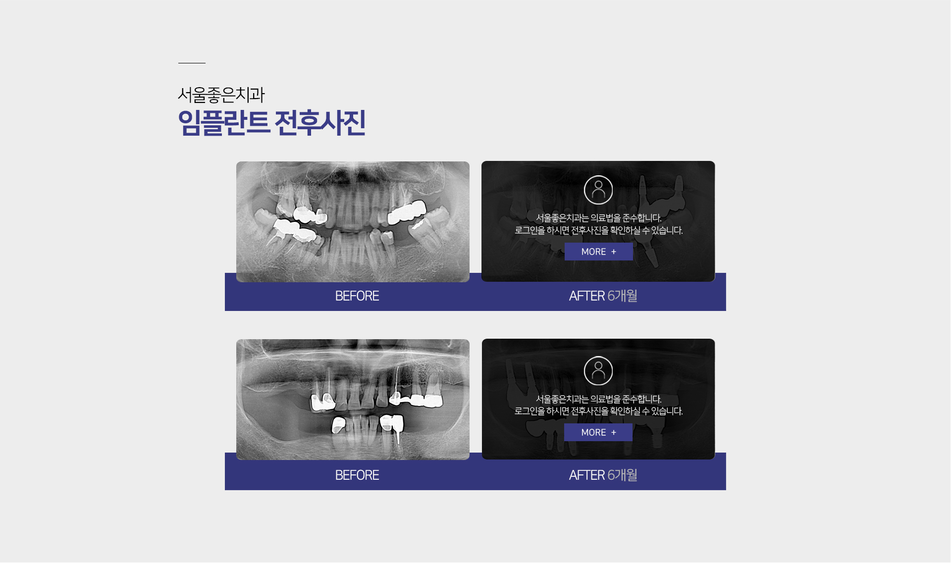 서울좋은치과병원-임플란트-전후사진
