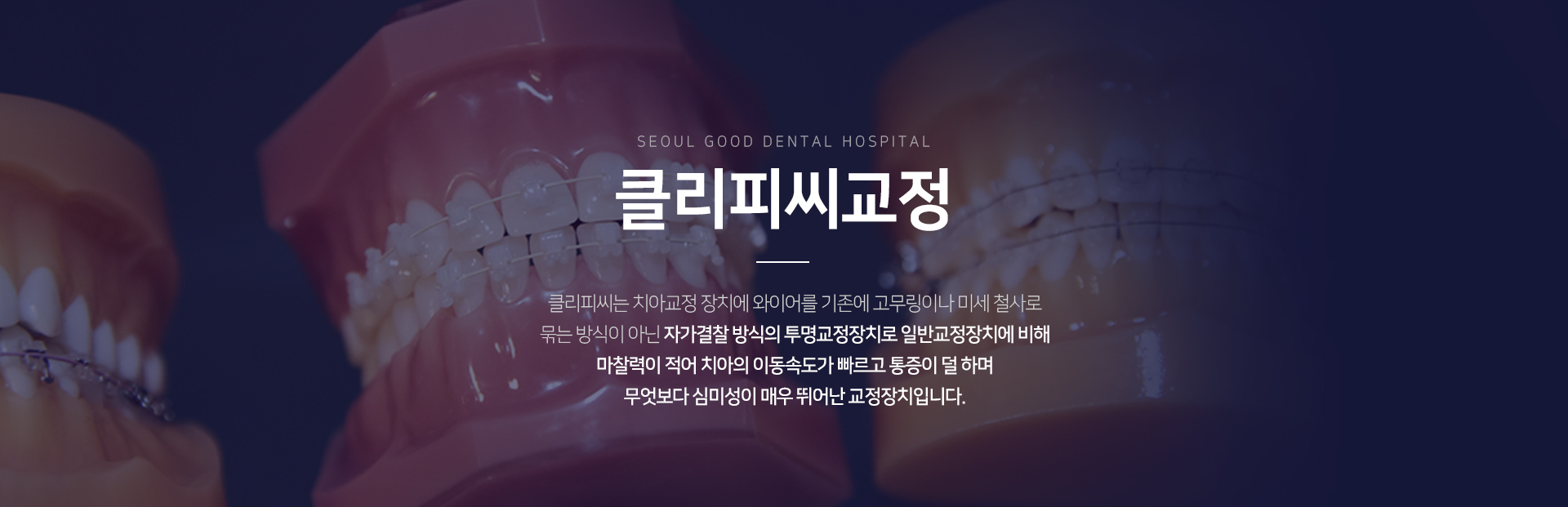 클리피씨-교정-클리피씨는-치아교정-장치에-와이어를-고무링이나-미세-철사로-묶는-방식이-아닌-자가결찰-방식의-투명교정장치로-일반교정장치에-비해-마찰력이-적어-치아의-이동속도가-빠르고-통증이-덜-하며-무엇보다-심미성이-매우-뛰어난-교정장치입니다