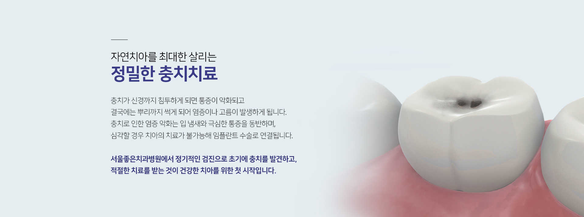 자연치아를-최대한-살리는-정밀한-충치치료-충치가-신경까지-침투하게-되면-통증이-악화되고-결국에는-뿌리까지-썩게-되어-염증이나-고름이-발생하게-됩니다-충치로-인한-염증-악화는-입-냄새와-극심한-통증을-동반하며-심각할-경우-치아의-치료가-불가능해-임플란트-수술로-연결됩니다-서울좋은치과병원에서-정기적인-검진으로-초기에-충치를-발견하고-적절한-치료를-받는-것이-건강한-치아를-위한-첫-시작입니다