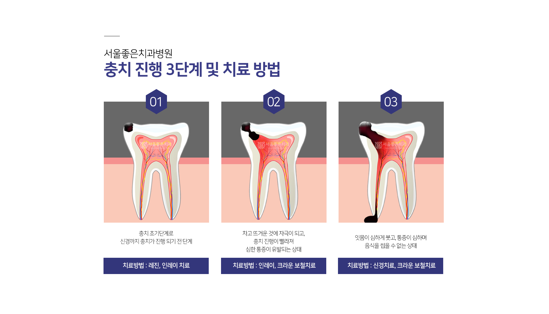 충치-진행-3단계-및-치료-방법-1단계-충치-초기-단계로-신경까지-충치가-진행되기-전-단계-치료방법-레진-인레이-치료-2단계-차고-뜨거운-것에-자극이-되고-충치-진행이-빨라져-심한-통증이-유발되는-상태-치료방법-인레이-크라운-보철치료-3단계-잇몸이-심하게-붓고-통증이-심하며-음식을-씹을-수-없는-상태-치료방법-신경치료-크라운-보철치료