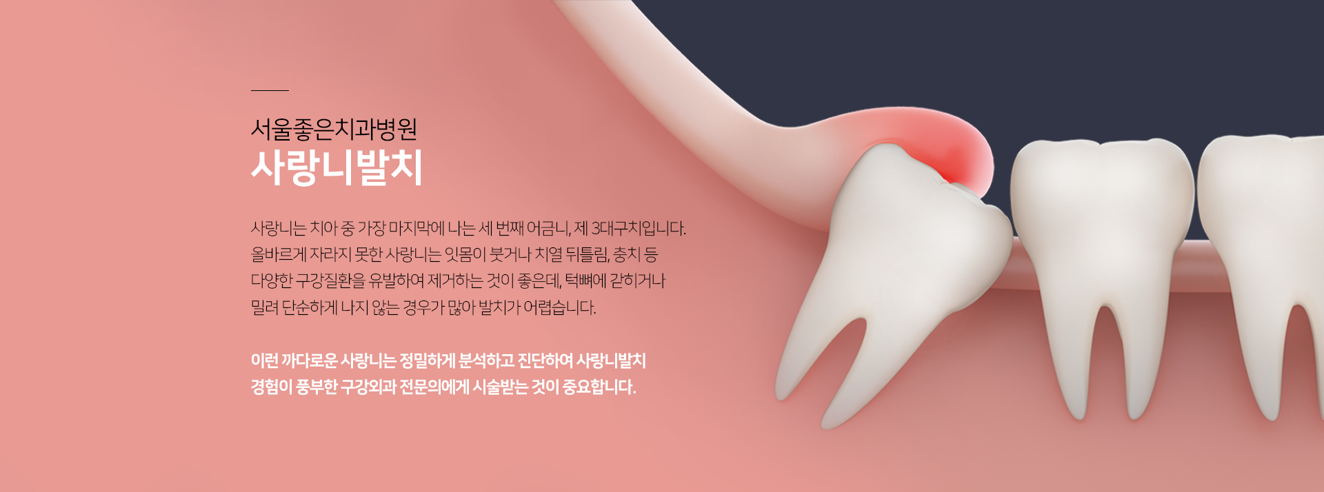 사랑니는-치아-중-가장-마지막에-나는-세-번째-어금니-제3대구치입니다-올바르게-자라지-못한-사랑니는-잇몸이-붓거나-치열-뒤틀림-충치-등-다양한-구강질환을-유발하여-제거하는-것이-좋은데-턱뼈에-갇히거나-밀려-단순하게-나지-않는-경우가-많아-발치가-어렵습니다-이런-까다로운-사랑니는-정밀하게-분석하고-진단하여-사랑니-발치-경험이-풍부한-구강외과-전문의에게-시술받는-것이-중요합니다