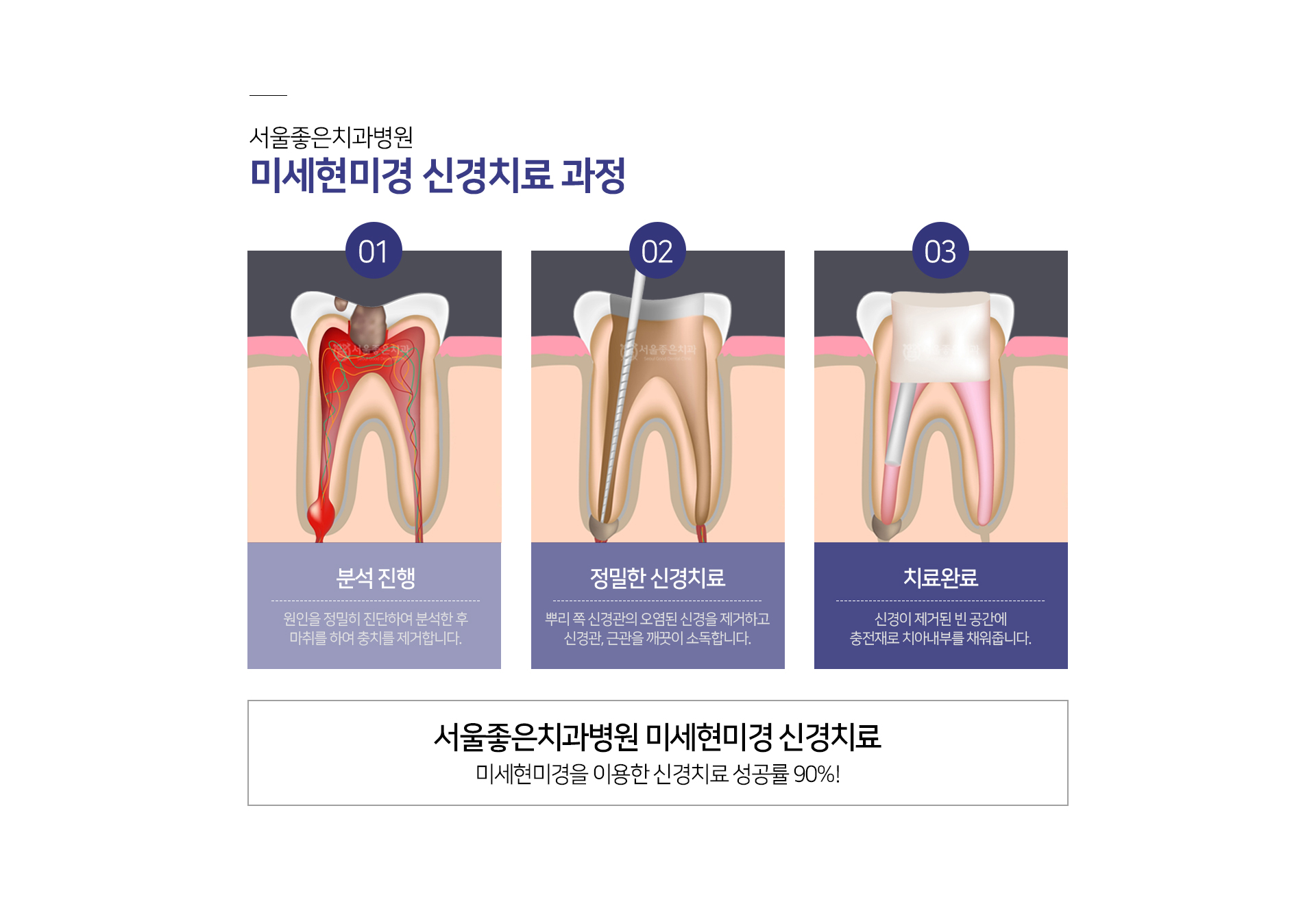 미세현미경-신경치료-과정-1단계-분석-진행-원인을-정밀히-진단하여-분석한-후-마취를-하여-충치를-제거합니다-2단계-정밀한-신경치료-뿌리-쪽-신경관의-오염된-신경을-제거하고-신경관-근관을-깨끗이-소독합니다-3단계-치료-완료-신경이-제거된-빈-공간에-충전재로-치아-내부를-채워줍니다-서울좋은치과병원-미세현미경-신경치료-성공률-90%