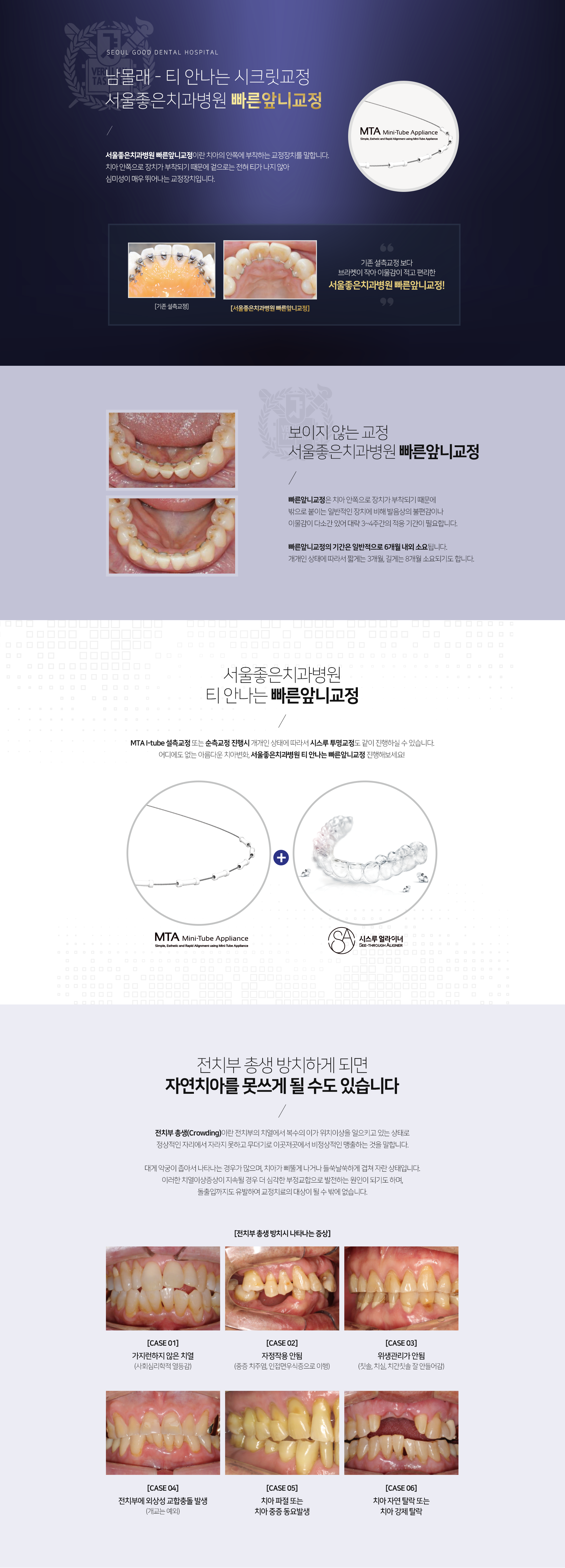 남몰래-티-안-나는-시크릿-교정-서울좋은치과병원-빠른-앞니-교정-치아의-안쪽에-부착하는-교정장치로-겉으로는-전혀-티가-나지-않아-심미성이-매우-뛰어납니다-기존-설측-교정보다-브라켓이-작아-이물감이-적고-편리합니다-치아-안쪽으로-장치가-부착되기-때문에-밖으로-붙이는-일반적인-장치에-비해-발음상의-불편감이나-이물감이-다소간-있어-대략-3~4주간의-적응-기간이-필요합니다-기간은-일반적으로-6개월-내외-소요됩니다-개개인-상태에-따라서-짧게는-3개월-길게는-8개월-소요되기도-합니다-전치부-총생-방치하게-되면-자연치아를-못쓰게-될-수도-있습니다-전치부-총생이란-전치부의-치열에서-복수의-이가-위치이상을-일으키고-있는-상태로-정상적인-자리에서-자라지-못하고-무더기로-이곳저곳에서-비정상적인-맹출-하는-것을-말합니다-전치부-총생-방치시-나타나는-증상-가지런하지-않은-치열-자정작용-안됨-위생관리가-안-됨-전치부에-외상성-교합-충돌-발생-치아-파절-또는-치아-중증-동요-발생-치아-자연-탈락-또는-치아-강제-탈락